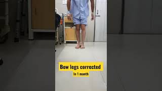 bow legs corrected