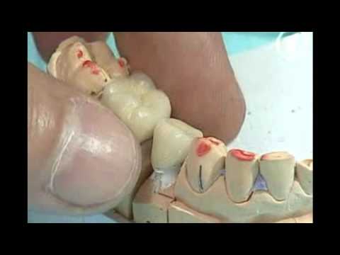 0 - Коричневий наліт на зубах: причини, як прибрати в домашніх умовах