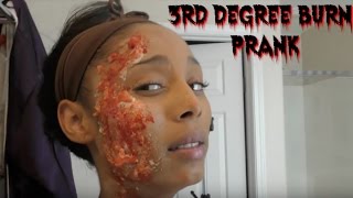 3rd Degree Burned Prank π₯