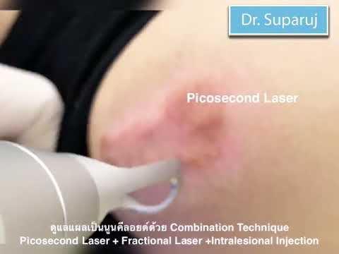 ดูแลแผลเป็นนูนคีลอยด์ด้วย Combination Technique : Picosecond Laser + Fractional Laser+Injection