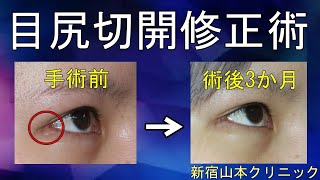 【韓国整形の目尻切開でを失敗】赤くめくれた目尻の修正手術☆新宿山本クリニック