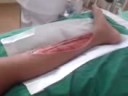 image Kaki Orang Ketagih Air Gas Kencing Manis