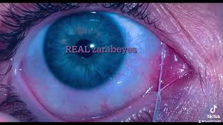 Eye Mucous Fishing Syndrome