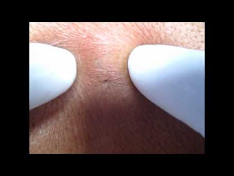 Sebaceous Cyst & Its Method Of Excision