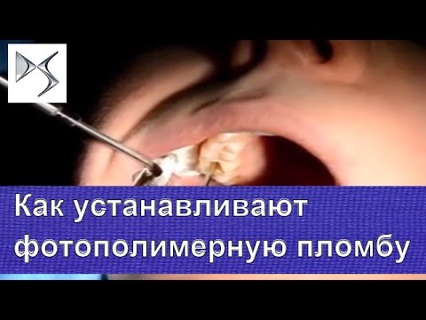 0 - Можна палити після пломбування зуба і тимчасової пломби