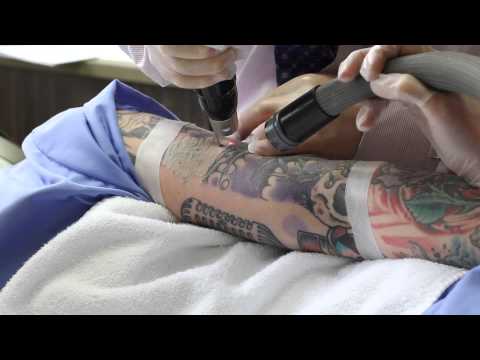 colorado tattoo removal images colorado tattoo removal images