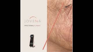 𝗳𝗮𝗰𝗲 𝗿𝗲𝗷𝘂𝘃𝗲𝗻𝗮𝘁𝗶𝗼𝗻 With Jovena - 𝘄𝗶𝘁𝗵𝗼𝘂𝘁 𝘀𝘂𝗿𝗴𝗲𝗿𝗶𝗲𝘀