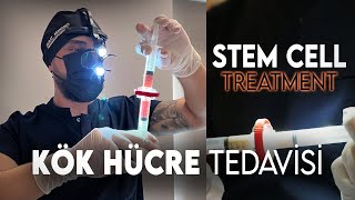 Saç Ekiminde Kök Hücre Tedavisi L Stem Cell Treatment In Hair Transplantation