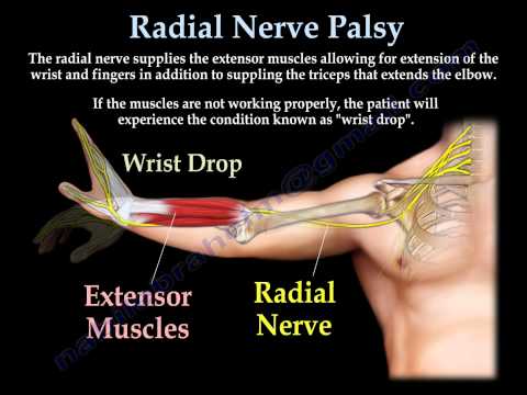 Radial Palsy