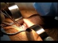 Penile Silicone Implant Removal Surgery