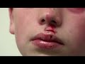 Split Lip - Bizarre ER