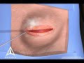 hernioplastia