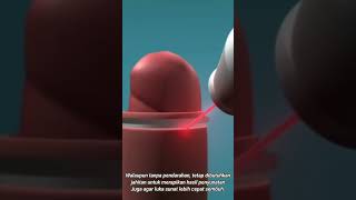 Animasi tutorial sunat laser || tutorial circumcision electrical cauter animatio