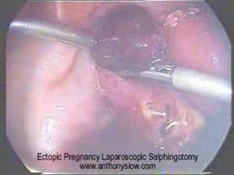 Ectopic Pregnancy on Outcomes For Women Who Have Had An Ectopic Pregnancy   Worldnews Com