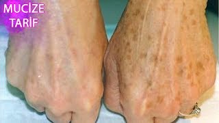 Eldeki̇ Lekeler - Yaşlilik Ve Hami̇leli̇k Lekeleri̇ Nasil Geçer - Muci̇ze Tari̇f - Güzellik Bakım