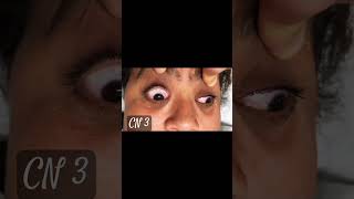 Right Oculomotor Cniii Palsy