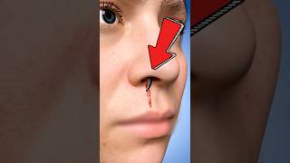A Live Leech In This Girls Nose