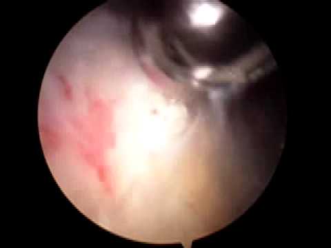 Calcific Tendonitis Shoulder Natural Treatment Calcific Tendonitis Shoulder Natural Treatment