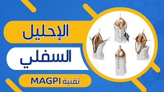 Episode Hypospadias Repair With Magpi Technique Kh