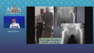 An Approach To Managing The Dysplastic Hip - David Choon