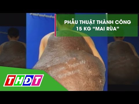 Phẫu thuật thành công cho chàng trai mang mai rùa 15 kg | THDT