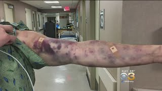 Mysterious Bug Bite Leaves Mans Arm Covered In Bruises