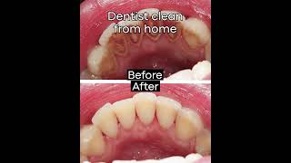 Smile Therapy-Ultrasonic Tooth Cleaner