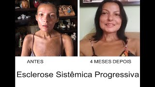 Adriana - Esclerose Sistêmica Progressiva (Esclerodermia)