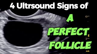 A Perfect Follicle 4 Ultrasound Signs - Of Good Follicle For Easy Conceiving