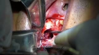 Sinus Elevation Using Tenting With Suture Technique Management Of Sinus Mucus Retention Cyst