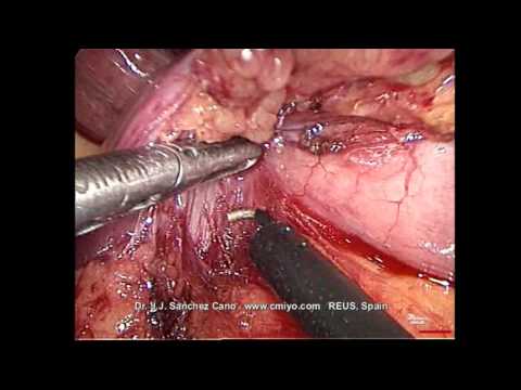 CANCER GASTRICO GASTRECTOMIA cancer gastrico gastrectomia: