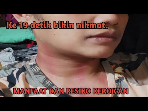 KEROKAN LEHER SAMPAI MERAH ||MASUK ANGIN.