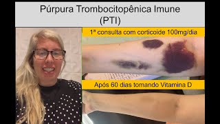 Aline - Púrpura Trombocitopênica Imune (PTI)