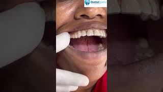 Pallil Kambi Idathe Pallu Sheriyakkan Clear Aligner Treatment For 52 Year Old Patient