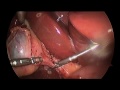 Adam Smith Single incision gall bladder removal