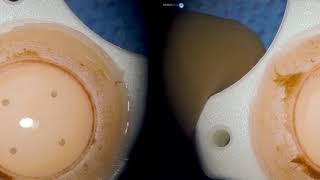 Surgery Penetrating Keratoplasty Dr. Roberto Pineda