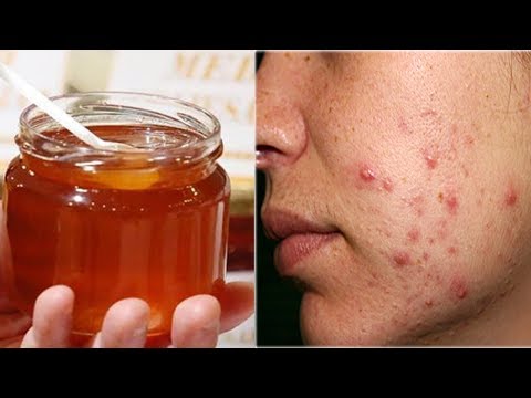 Cách trị mụn bằng mật ong ngay tại nhà hiệu quả 100% khiến chị em mê mẩn