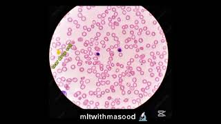 N Rbc, Target Cell, Crenated Cell, Ovalocyte, Elliptocyte ,Platelets Microcytic Hypochromic Rbc