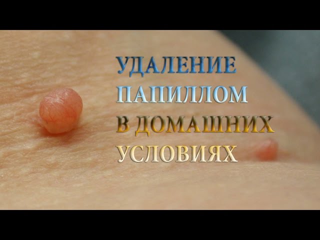 Чем удалить кондилому в домашних условиях Чем удалить кондилому в домашних условиях