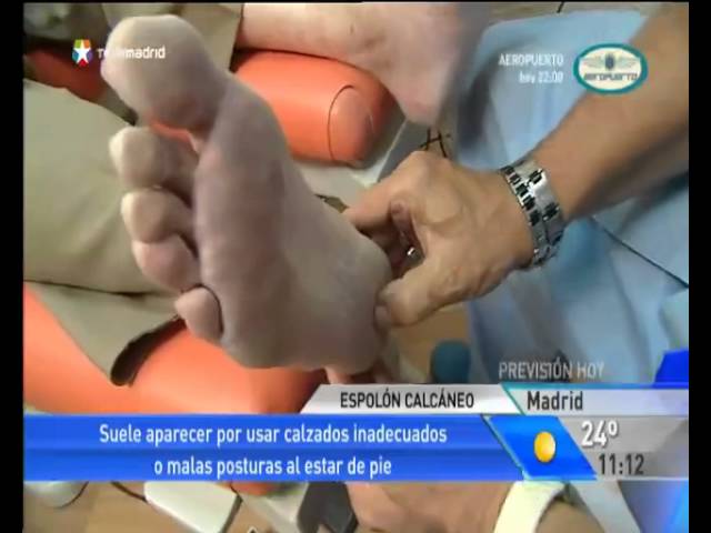 El+espol%c3%b3n+calc%c3%a1neo