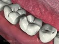 Tooth Decay (Dental Caries)