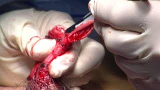 Partial Penectomy And Sentinel-Node Biopsy For Penile Cancer