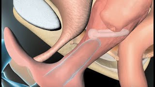 Uterine Prolapse and Incontinence Treatment: Pessary Insertion