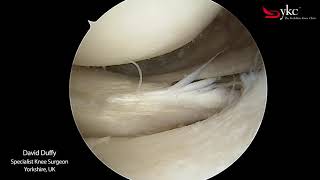 Watch a Knee Surgeon Treat a Meniscal Tear