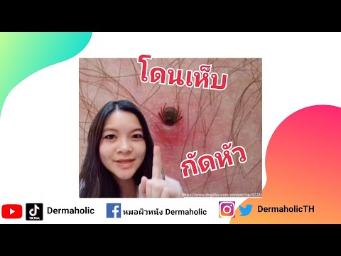 โดนเห็บกัดหัว | เห็บ เห็บกัด ผื่น หมอ หมอผิวหนัง หมอแนน dermaholic