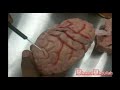 Cerebrum