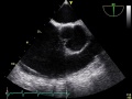 Rupture aneurysm of Sinus of valsalva, 2D, TEE