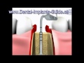 Dental implant procedure