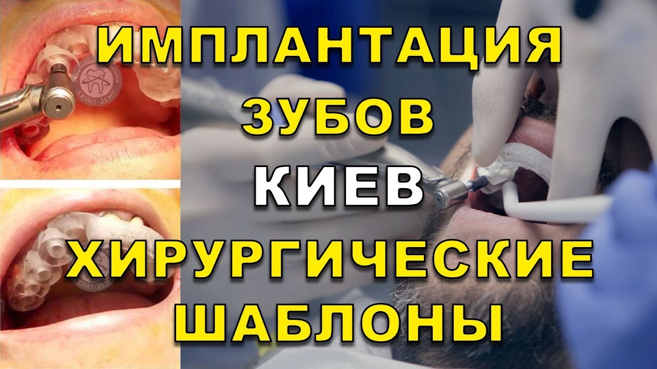 Имплантант зубов киев Имплантант зубов киев