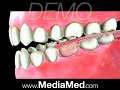 Dental Implant-Cosmetic